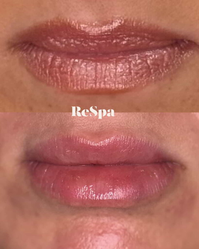 Before and After Image: Lip Fillers - front