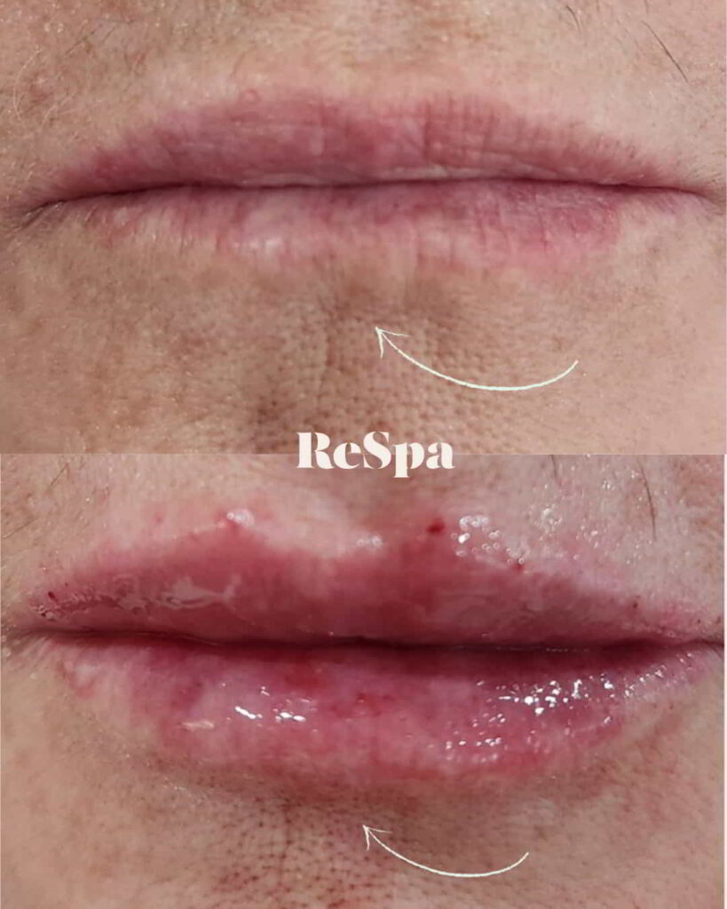 Before and After Image: Lip Fillers - front