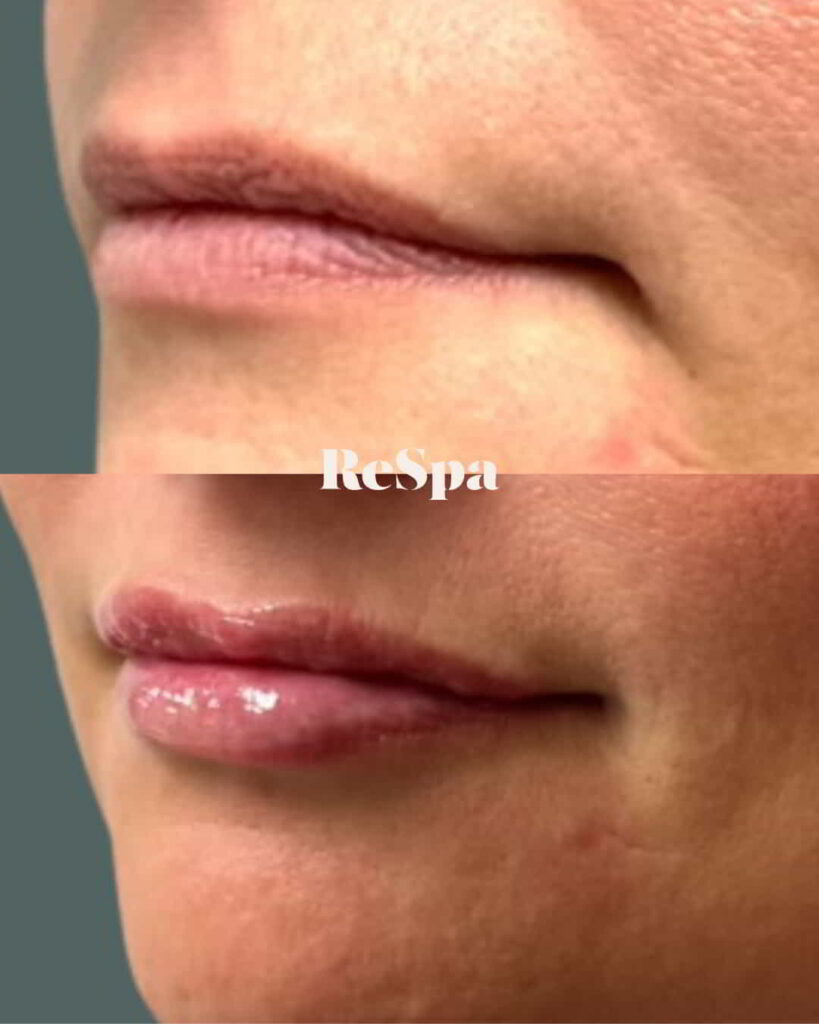 Before and After Image: Lip Fillers - left-side