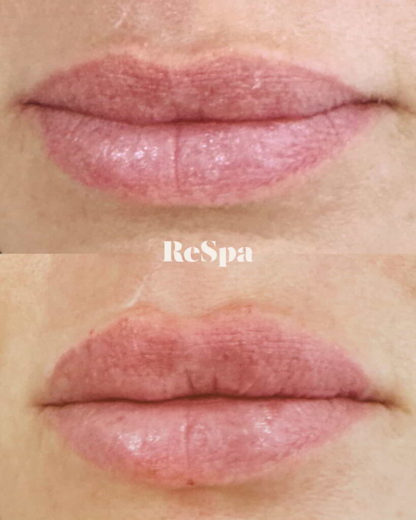 Before and After Image: Lip Fillers - front