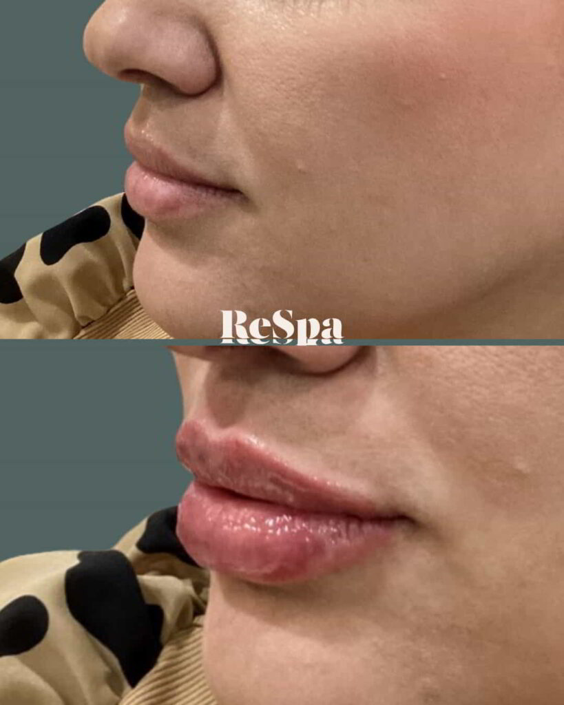 Before and After Image: Lip Fillers - left-side