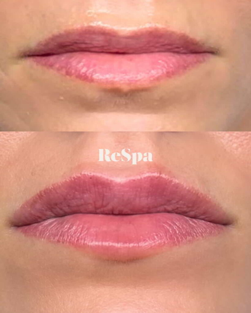 Before and After Image: Lip Fillers - front