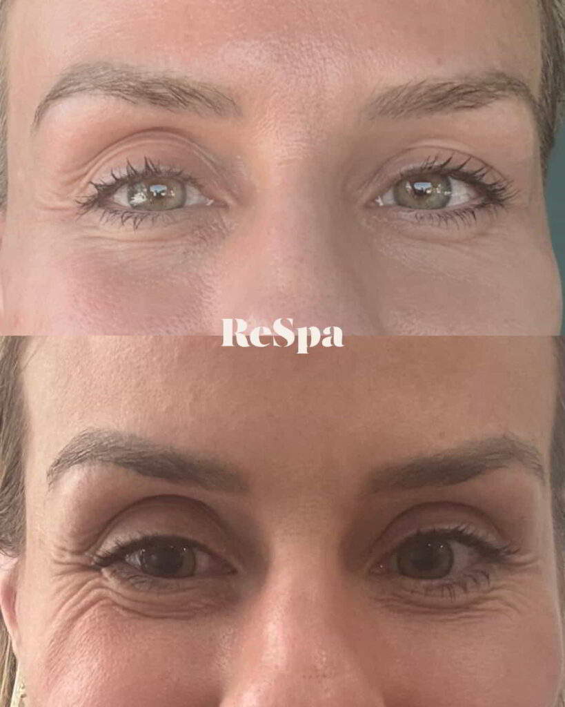 Before and After Image: PRF Undereye Injections - front