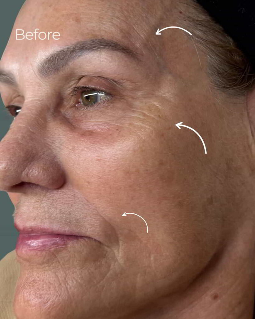 Before Image: PRX Derm Perfection - left-front-oblique
