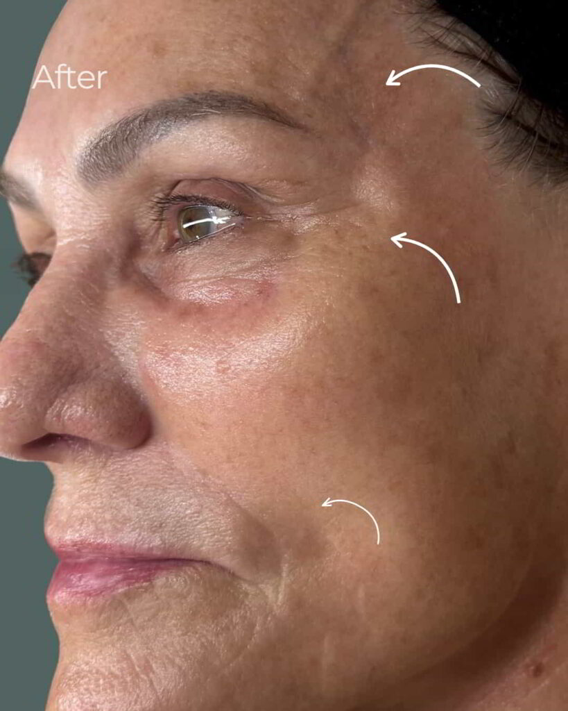 After Image: PRX Derm Perfection - left-front-oblique