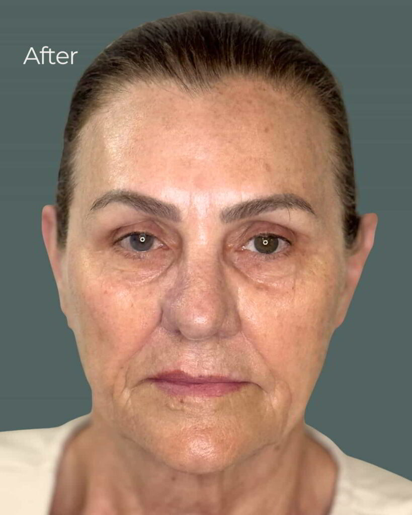 After Image: PRX Derm Perfection - front