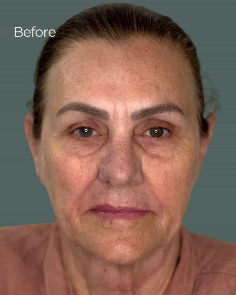 Before Image: PRX Derm Perfection - front