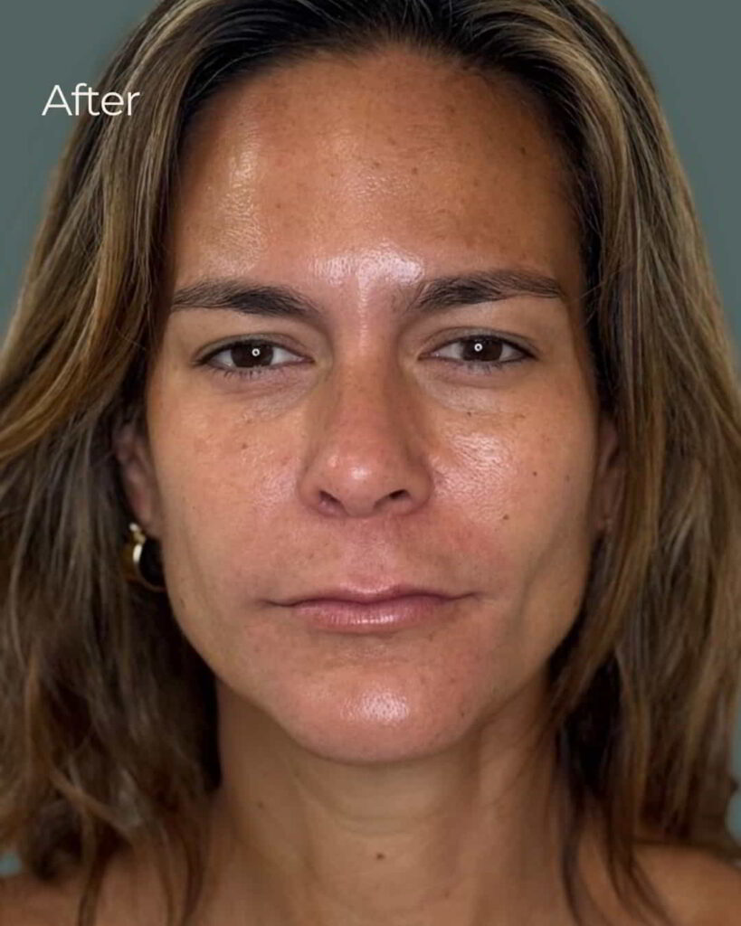 After Image: PRX Derm Perfection - front