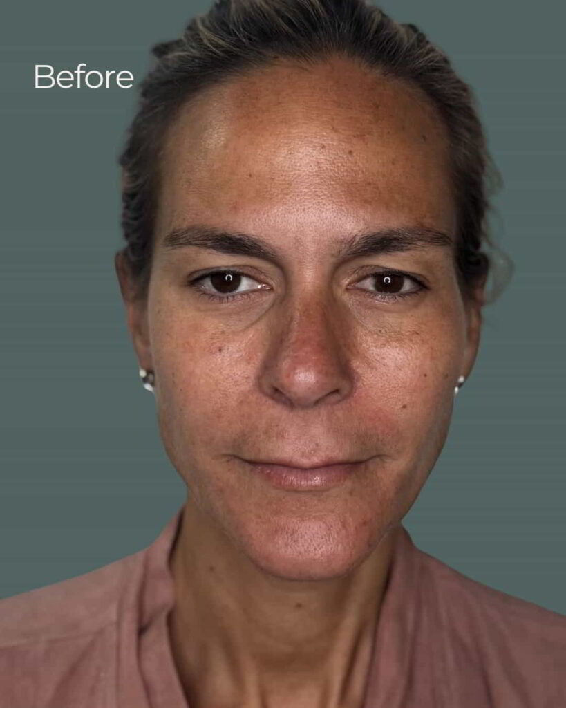 Before Image: PRX Derm Perfection - front