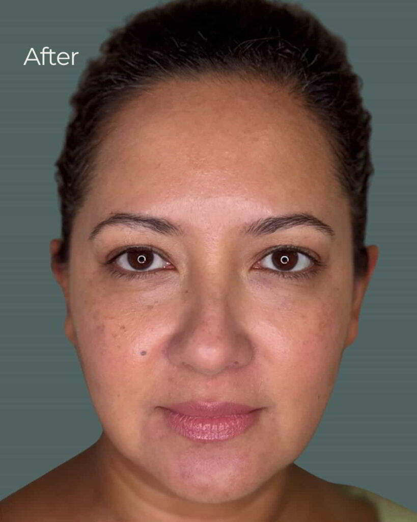 After Image: PRX Derm Perfection - front