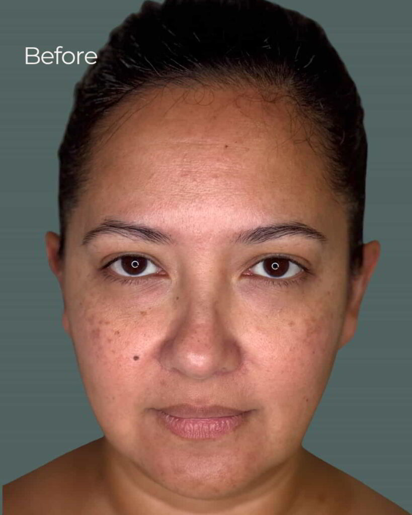 Before Image: PRX Derm Perfection - front