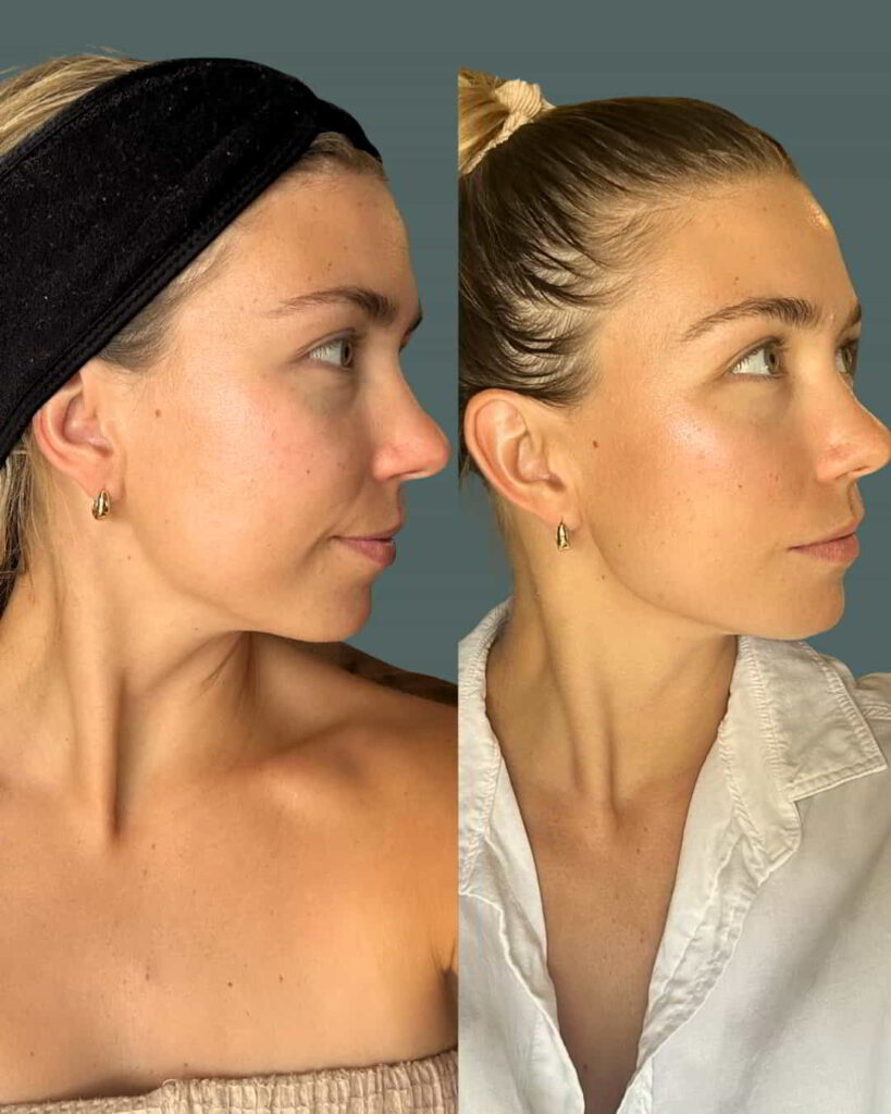 Before and After Image: EXION RF ULTRASOUND - right-front-oblique